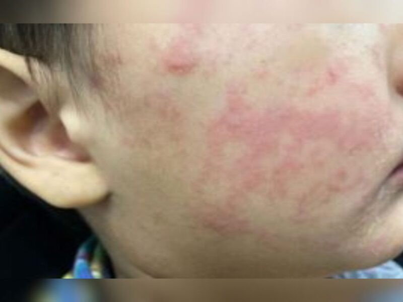 Measles rash